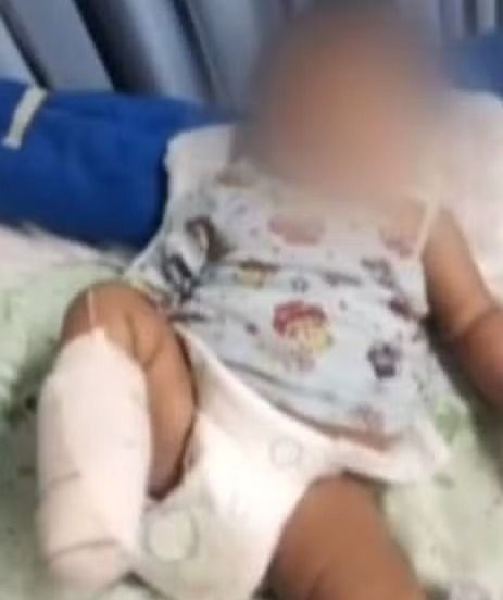 Bebê tem pé amputado após suspeita de negligência médica em hospital de Ilhéus