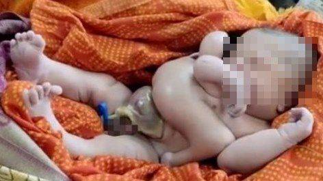 Bebê nascido com quatro braços e quatro pernas é tratado como divindade