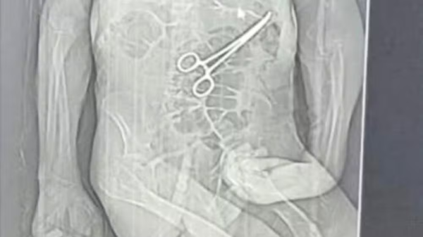 Após morte de idoso em MG, família acusa hospital de esquecer pinça cirúrgica em paciente