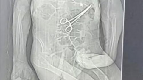 Após morte de idoso em MG, família acusa hospital de esquecer pinça cirúrgica em paciente