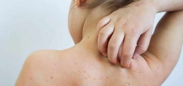 Sarampo cresce 32 vezes nas Américas em um ano