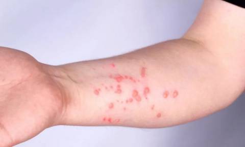 Feira de Santana mantém alerta contra Mpox, mas não registra casos da doença