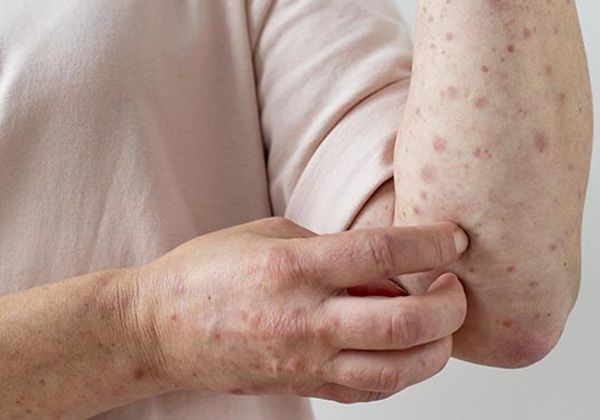 Brasil registra 129 casos confirmados de mpox em 2026