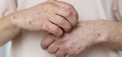 Mpox no Brasil: 149 casos atingem 13 estados, alerta Ministério da Saúde